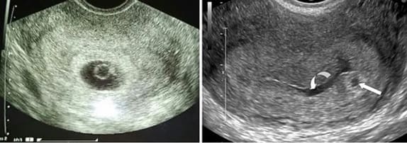 1 Haftalık Bebek Ultrason Görüntüsü