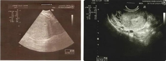 1 Haftalık Gebelik Ultrason Görüntüleri