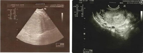 1 Haftalık Gebelik Ultrason Görüntüleri 1 Haftalık Gebelik Ultrason Görüntüleri