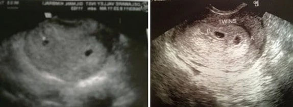 1 Haftalık İkiz Gebelik Ultrason Görüntüleri