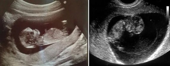 10 Haftalık Bebek Ultrason Görüntüsü