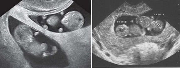 10 Haftalık İkiz Gebelik Ultrason Görüntüleri