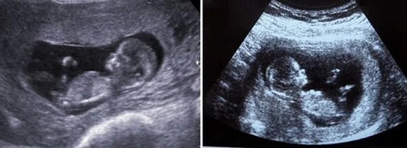 11 Haftalık Bebek Ultrason Görüntüsü