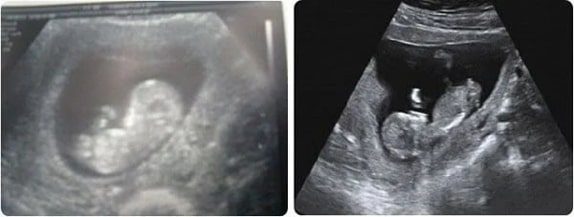 11 Haftalık Gebelik Ultrason Görüntüleri