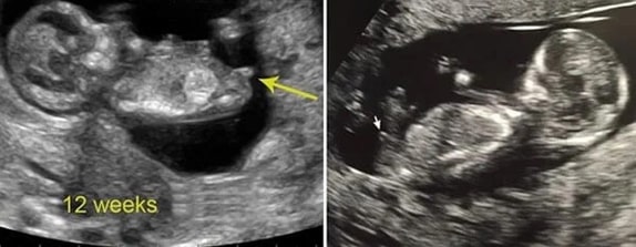 12 Haftalık Erkek Bebek Ultrason Görüntüsü