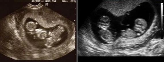 12 Haftalık İkiz Gebelik Ultrason Görüntüleri