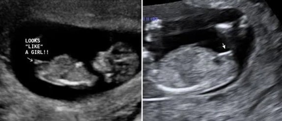 12 Haftalık Kız Bebek Ultrason Görüntüsü