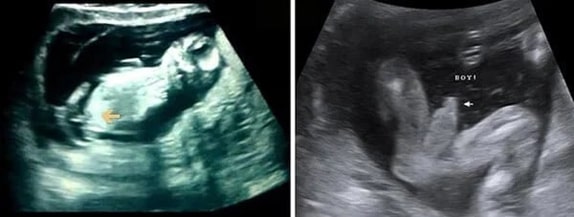 13 Haftalık Erkek Bebek Ultrason Görüntüsü