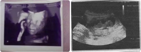 13 Haftalık Gebelik Ultrason Görüntüleri