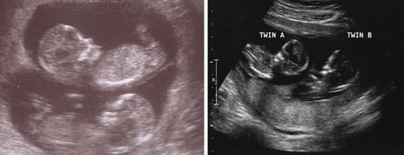 13 Haftalık İkiz Gebelik Ultrason Görüntüleri