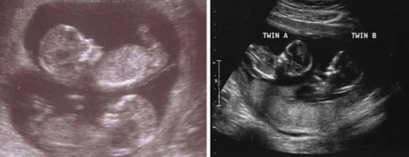 13 Haftalık İkiz Gebelik Ultrason Görüntüleri 13 Haftalık İkiz Gebelik Ultrason Görüntüleri