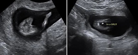 13 Haftalık Kız Bebek Ultrason Görüntüsü 13 Haftalık Kız Bebek Ultrason Görüntüsü