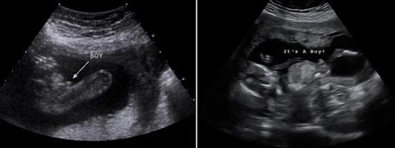 14 Haftalık Erkek Bebek Ultrason Görüntüsü