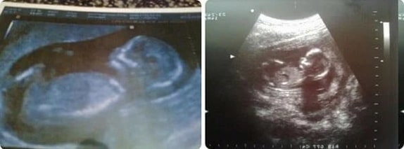 14 Haftalık Gebelik Ultrason Görüntüleri 14 Haftalık Gebelik Ultrason Görüntüleri