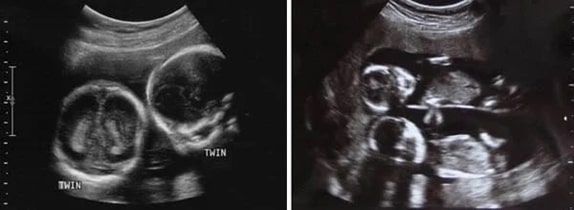 14 Haftalık İkiz Gebelik Ultrason Görüntüleri