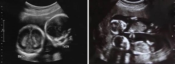 14 Haftalık İkiz Gebelik Ultrason Görüntüleri 14 Haftalık İkiz Gebelik Ultrason Görüntüleri
