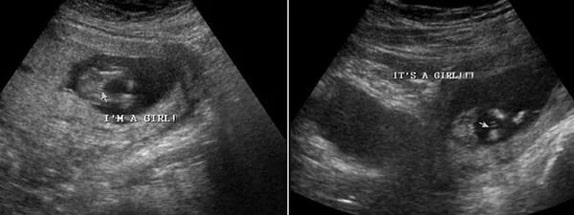 14 Haftalık Kız Bebek Ultrason Görüntüsü