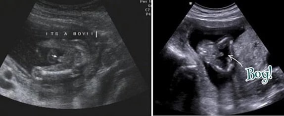 15 Haftalık Erkek Bebek Ultrason Görüntüsü