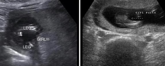 15 Haftalık Kız Bebek Ultrason Görüntüsü
