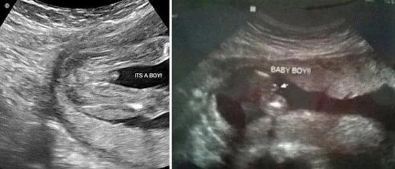 16 Haftalık Erkek Bebek Ultrason Görüntüsü