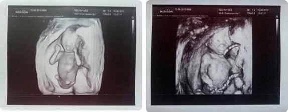 16 Haftalık Gebelik Ultrason Görüntüleri
