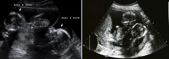 16 Haftalık İkiz Gebelik Ultrason Görüntüleri