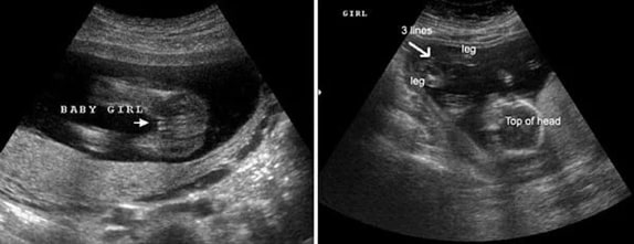 16 Haftalık Kız Bebek Ultrason Görüntüsü