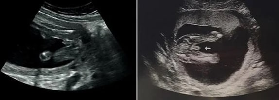 17 Haftalık Erkek Bebek Ultrason Görüntüsü