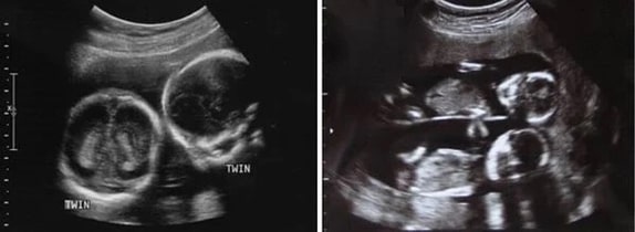 17 Haftalık İkiz Gebelik Ultrason Görüntüleri