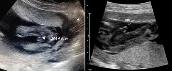 18 Haftalık Erkek Bebek Ultrason Görüntüsü