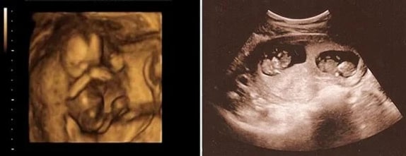 18 Haftalık İkiz Gebelik Ultrason Görüntüleri