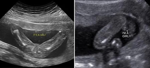 18 Haftalık Kız Bebek Ultrason Görüntüsü