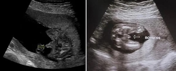 19 Haftalık Erkek Bebek Ultrason Görüntüsü