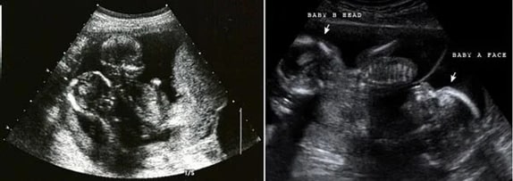 19 Haftalık İkiz Gebelik Ultrason Görüntüleri
