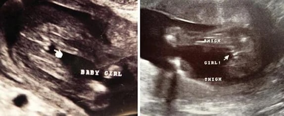 19 Haftalık Kız Bebek Ultrason Görüntüsü