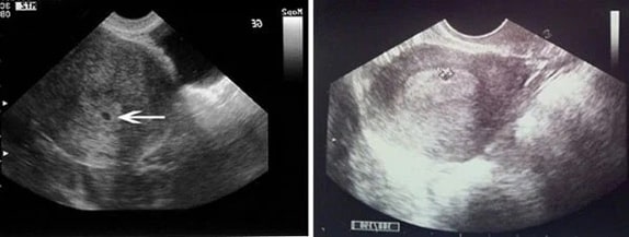 2 Haftalık Bebek Ultrason Görüntüsü