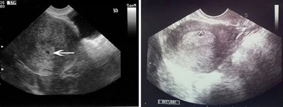 2 Haftalık Bebek Ultrason Görüntüsü 2 Haftalık Bebek Ultrason Görüntüsü