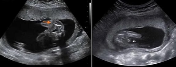 20 Haftalık Erkek Bebek Ultrason Görüntüsü