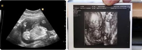 20 Haftalık Gebelik Ultrason Görüntüleri