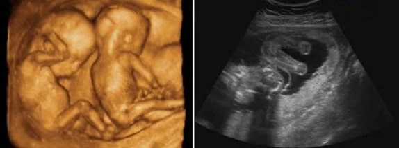 20 Haftalık İkiz Gebelik Ultrason Görüntüleri