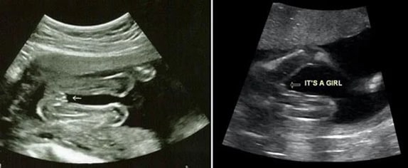 20 Haftalık Kız Bebek Ultrason Görüntüsü 20 Haftalık Kız Bebek Ultrason Görüntüsü