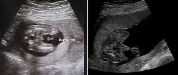 21 Haftalık Erkek Bebek Ultrason Görüntüsü