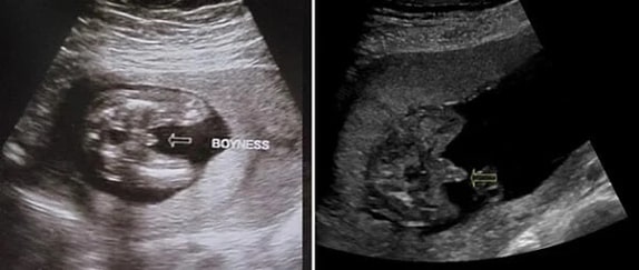 21 Haftalık Erkek Bebek Ultrason Görüntüsü 21 Haftalık Erkek Bebek Ultrason Görüntüsü