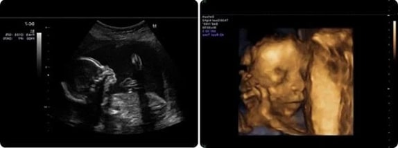 21 Haftalık Gebelik Ultrason Görüntüleri