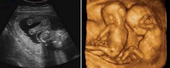 21 Haftalık İkiz Gebelik Ultrason Görüntüleri