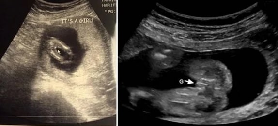 21 Haftalık Kız Bebek Ultrason Görüntüsü 21 Haftalık Kız Bebek Ultrason Görüntüsü