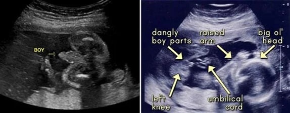22 Haftalık Erkek Bebek Ultrason Görüntüsü
