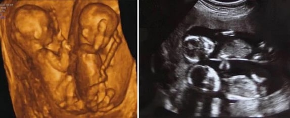 22 Haftalık İkiz Gebelik Ultrason Görüntüleri