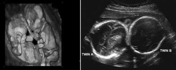 23 Haftalık İkiz Gebelik Ultrason Görüntüleri