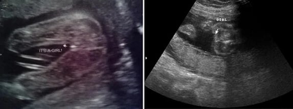 23 Haftalık Kız Bebek Ultrason Görüntüsü